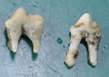 歯石で歯周病になり抜歯した歯